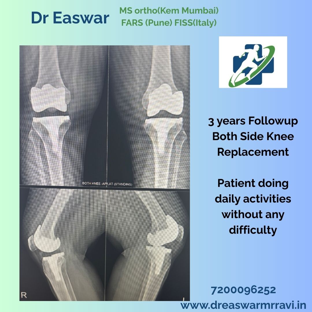 TKR followup